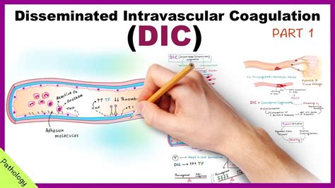 Disseminated intravascular coagulation ( DIC) is a condition in which blood clots form throughout the body, blocking small blood vessels. [1] Symptoms may include chest pain, shortness of breath, leg pain, problems speaking, or problems moving parts of the body. [1] As clotting factors and platelets are used up, bleeding may occur. [1] 